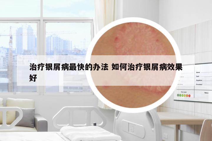 治療銀屑病最快的辦法 如何治療銀屑病效果好
