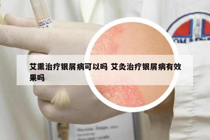 艾熏治療銀屑病可以嗎 艾灸治療銀屑病有效果嗎