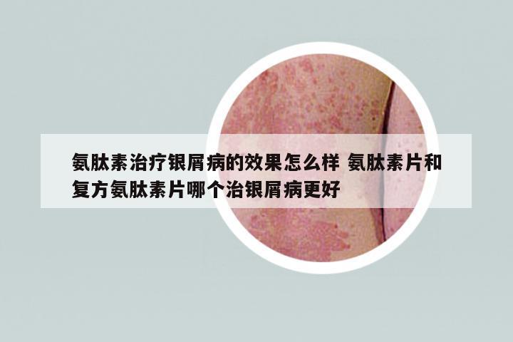 氨肽素治療銀屑病的效果怎么樣 氨肽素片和復方氨肽素片哪個治銀屑病更好