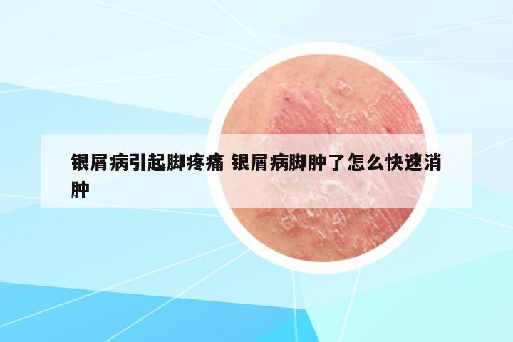銀屑病引起腳疼痛 銀屑病腳腫了怎么快速消腫