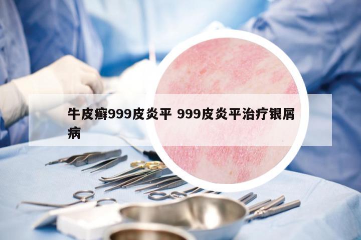 牛皮癬999皮炎平 999皮炎平治療銀屑病
