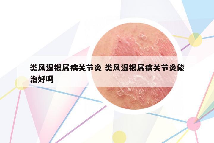類(lèi)風(fēng)濕銀屑病關(guān)節(jié)炎 類(lèi)風(fēng)濕銀屑病關(guān)節(jié)炎能治好嗎