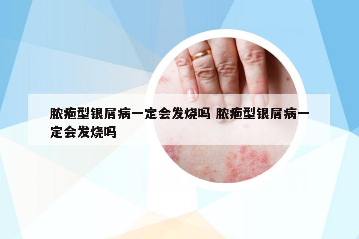 膿皰型銀屑病一定會發(fā)燒嗎 膿皰型銀屑病一定會發(fā)燒嗎