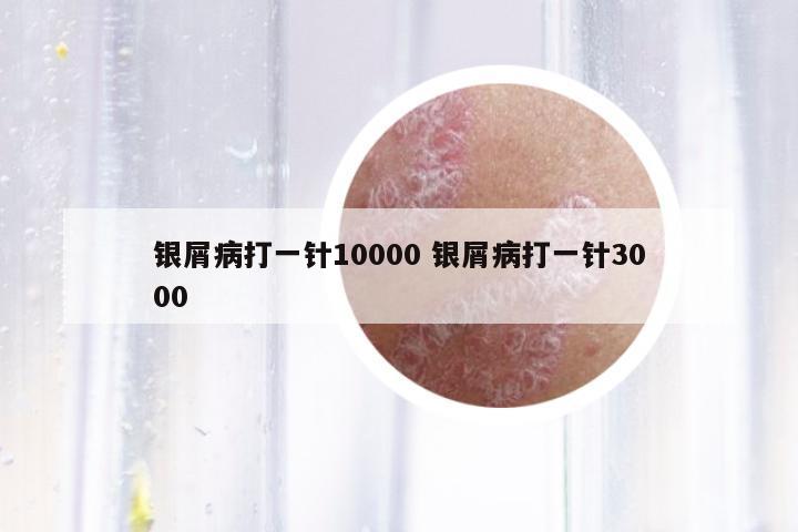 銀屑病打一針10000 銀屑病打一針3000