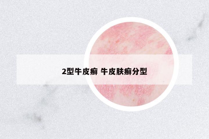 2型牛皮癬 牛皮膚癬分型