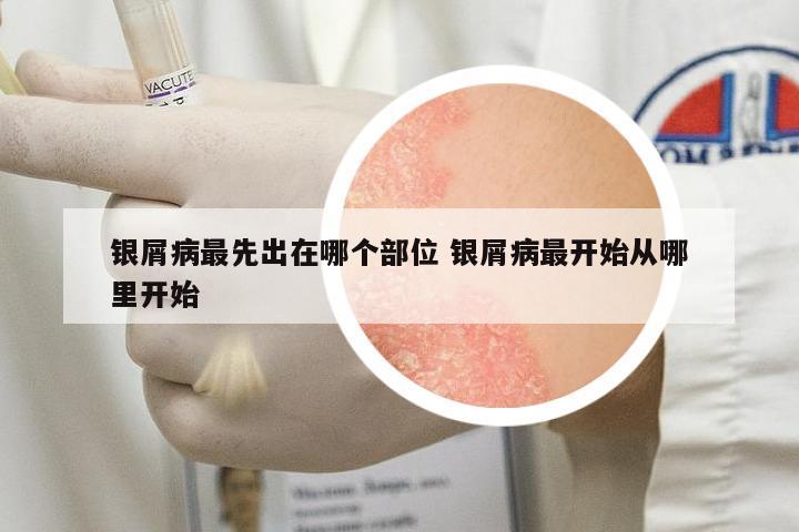 銀屑病最先出在哪個(gè)部位 銀屑病最開始從哪里開始