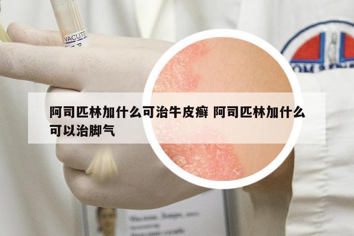 阿司匹林加什么可治牛皮癬 阿司匹林加什么可以治腳氣