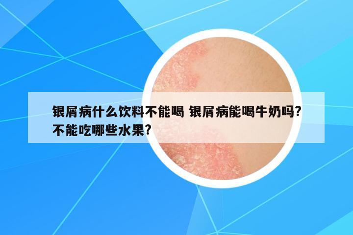 銀屑病什么飲料不能喝 銀屑病能喝牛奶嗎?不能吃哪些水果?