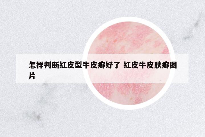 怎樣判斷紅皮型牛皮癬好了 紅皮牛皮膚癬圖片