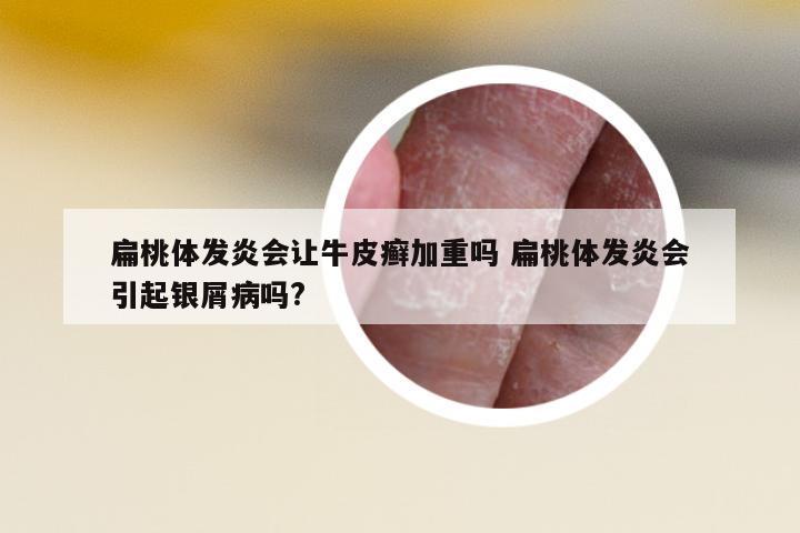 扁桃體發(fā)炎會讓牛皮癬加重嗎 扁桃體發(fā)炎會引起銀屑病嗎?