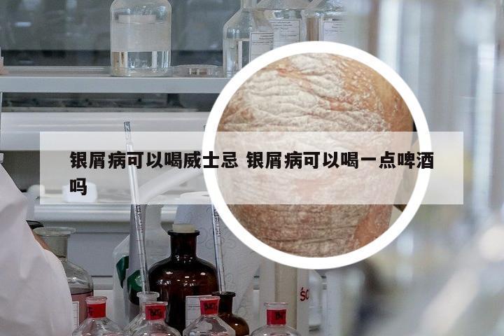 銀屑病可以喝威士忌 銀屑病可以喝一點(diǎn)啤酒嗎