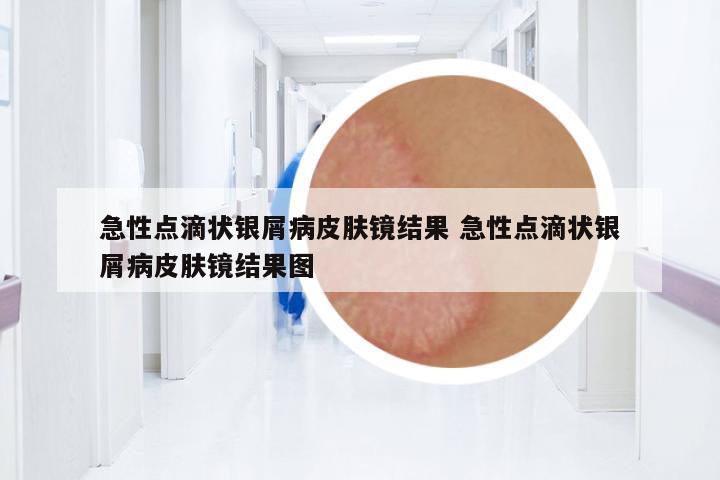 急性點(diǎn)滴狀銀屑病皮膚鏡結(jié)果 急性點(diǎn)滴狀銀屑病皮膚鏡結(jié)果圖