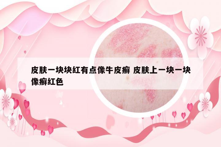 皮膚一塊塊紅有點(diǎn)像牛皮癬 皮膚上一塊一塊像癬紅色
