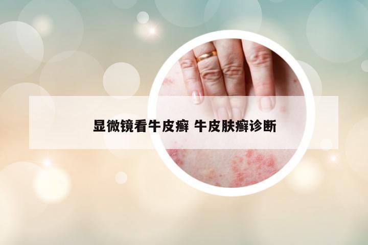 顯微鏡看牛皮癬 牛皮膚癬診斷