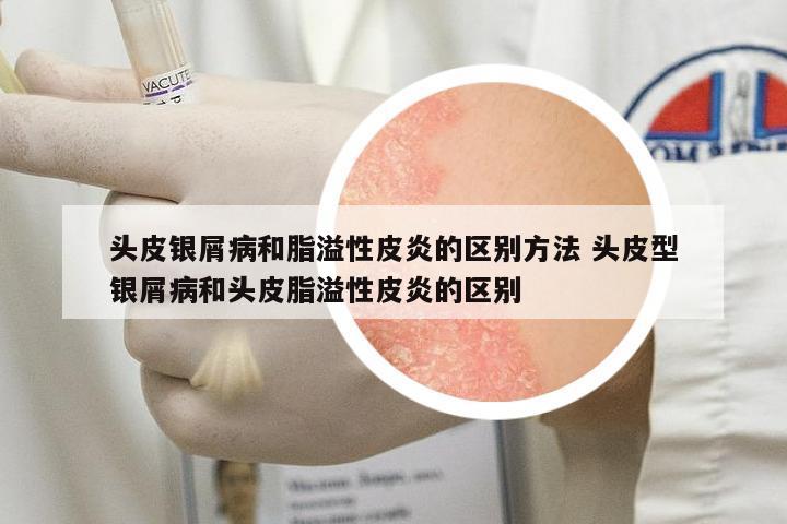 頭皮銀屑病和脂溢性皮炎的區(qū)別方法 頭皮型銀屑病和頭皮脂溢性皮炎的區(qū)別