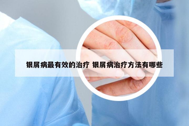 銀屑病最有效的治療 銀屑病治療方法有哪些