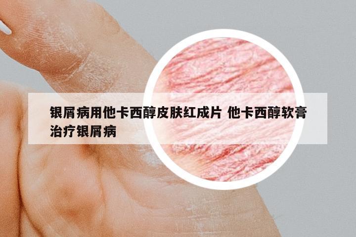 銀屑病用他卡西醇皮膚紅成片 他卡西醇軟膏治療銀屑病