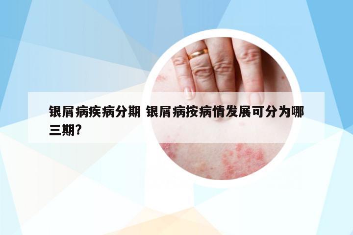 銀屑病疾病分期 銀屑病按病情發(fā)展可分為哪三期?