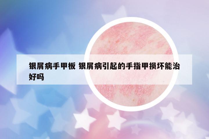 銀屑病手甲板 銀屑病引起的手指甲損壞能治好嗎