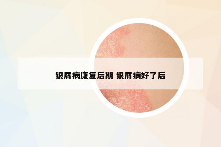 銀屑病康復(fù)后期 銀屑病好了后