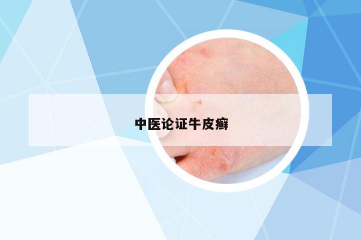 中醫(yī)論證牛皮癬