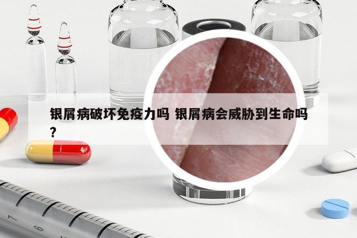 銀屑病破壞免疫力嗎 銀屑病會(huì)威脅到生命嗎?