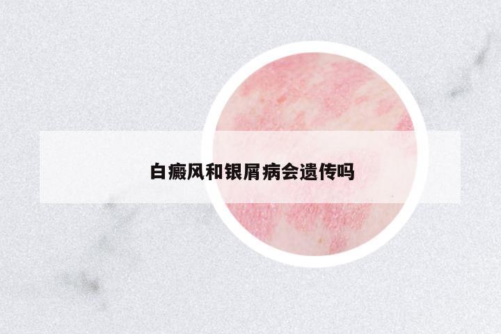 白癜風(fēng)和銀屑病會(huì)遺傳嗎