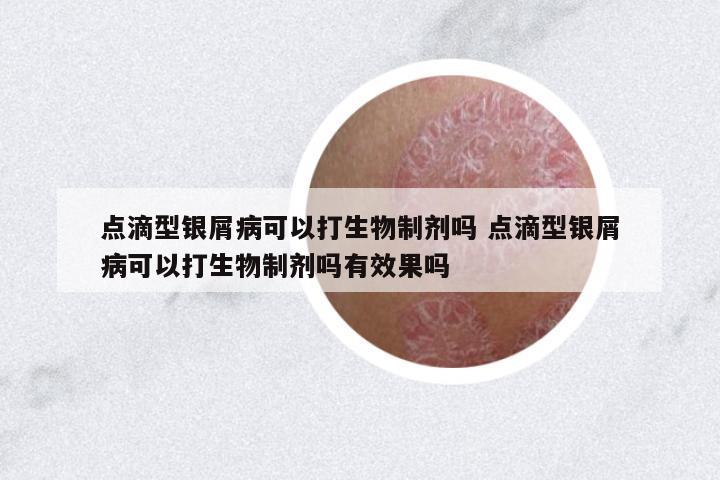 點滴型銀屑病可以打生物制劑嗎 點滴型銀屑病可以打生物制劑嗎有效果嗎