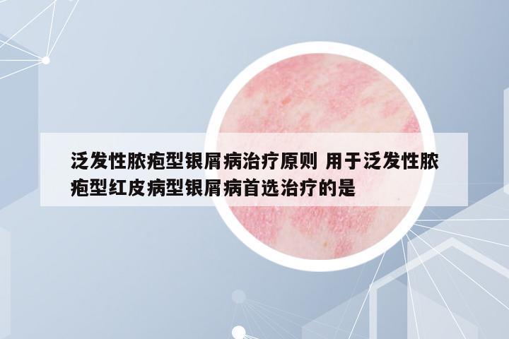 泛發(fā)性膿皰型銀屑病治療原則 用于泛發(fā)性膿皰型紅皮病型銀屑病首選治療的是