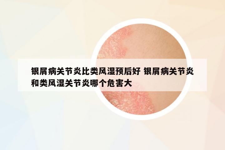 銀屑病關(guān)節(jié)炎比類風(fēng)濕預(yù)后好 銀屑病關(guān)節(jié)炎和類風(fēng)濕關(guān)節(jié)炎哪個危害大