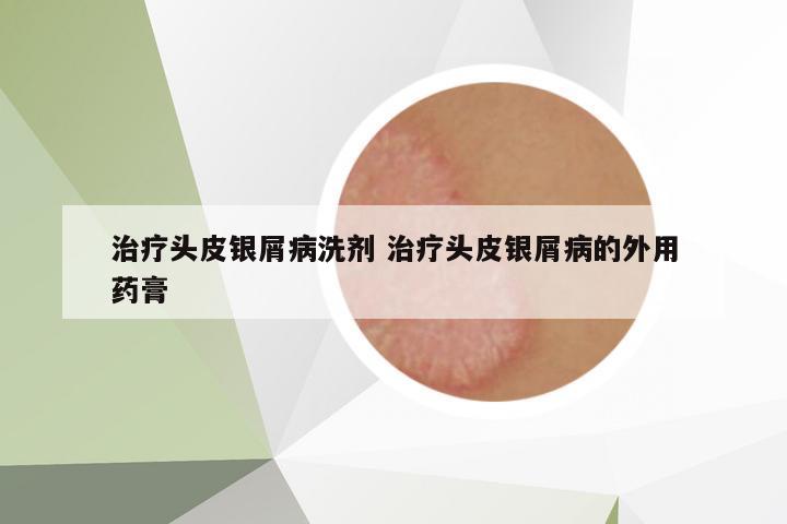 治療頭皮銀屑病洗劑 治療頭皮銀屑病的外用藥膏