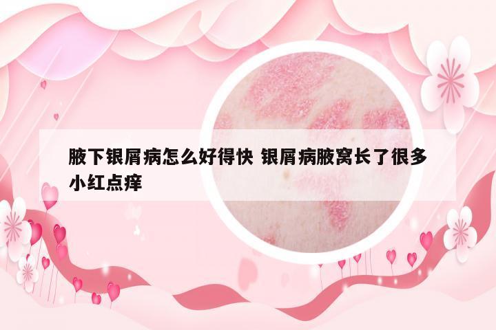 腋下銀屑病怎么好得快 銀屑病腋窩長了很多小紅點癢