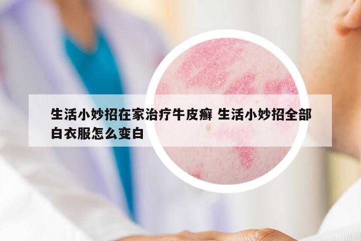 生活小妙招在家治療牛皮癬 生活小妙招全部白衣服怎么變白