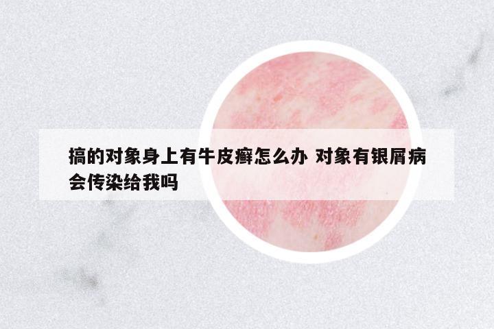 搞的對象身上有牛皮癬怎么辦 對象有銀屑病會傳染給我嗎