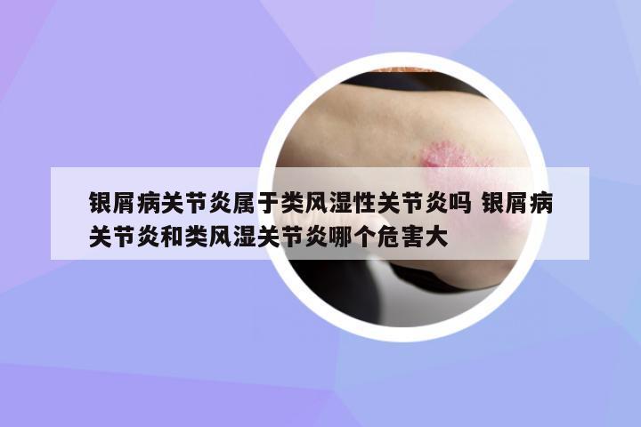 銀屑病關(guān)節(jié)炎屬于類風(fēng)濕性關(guān)節(jié)炎嗎 銀屑病關(guān)節(jié)炎和類風(fēng)濕關(guān)節(jié)炎哪個(gè)危害大