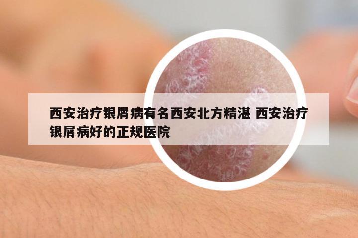 西安治療銀屑病有名西安北方精湛 西安治療銀屑病好的正規(guī)醫(yī)院