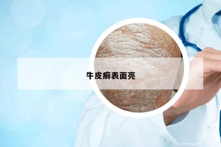 牛皮癬表面亮