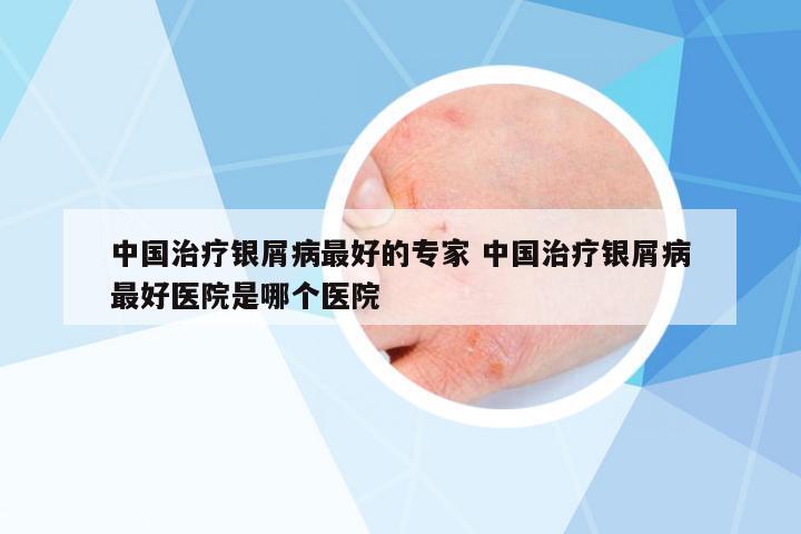 中國治療銀屑病最好的專家 中國治療銀屑病最好醫(yī)院是哪個醫(yī)院