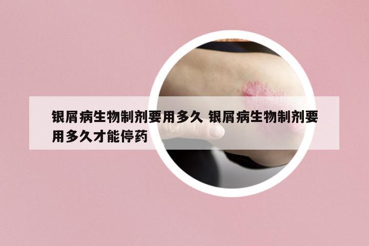 銀屑病生物制劑要用多久 銀屑病生物制劑要用多久才能停藥