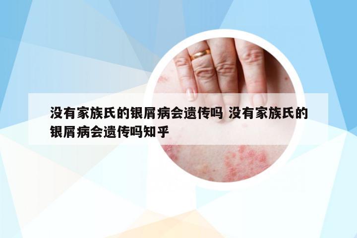 沒有家族氏的銀屑病會遺傳嗎 沒有家族氏的銀屑病會遺傳嗎知乎