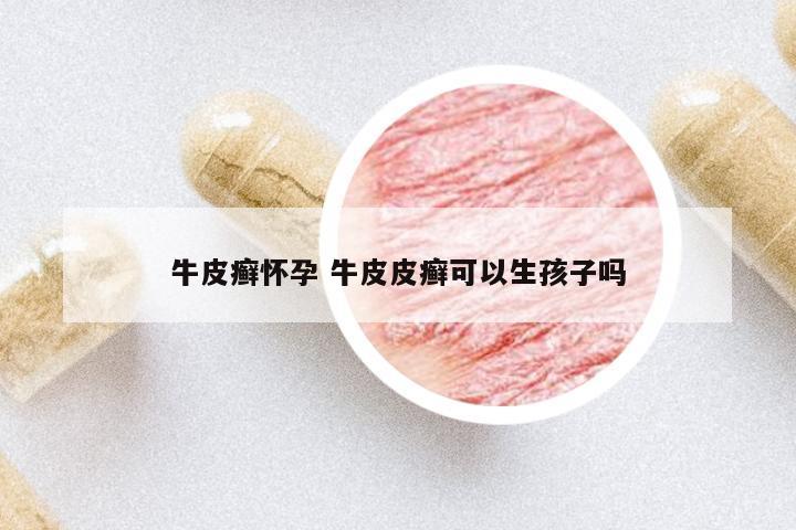 牛皮癬懷孕 牛皮皮癬可以生孩子嗎