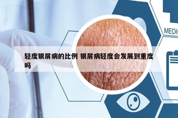輕度銀屑病的比例 銀屑病輕度會(huì)發(fā)展到重度嗎