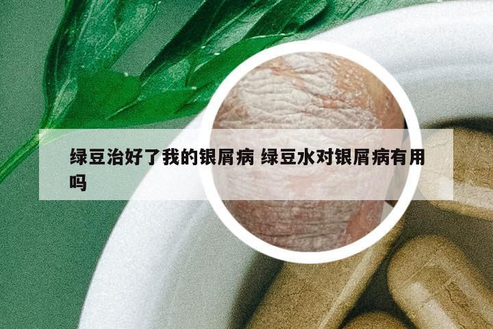 綠豆治好了我的銀屑病 綠豆水對銀屑病有用嗎