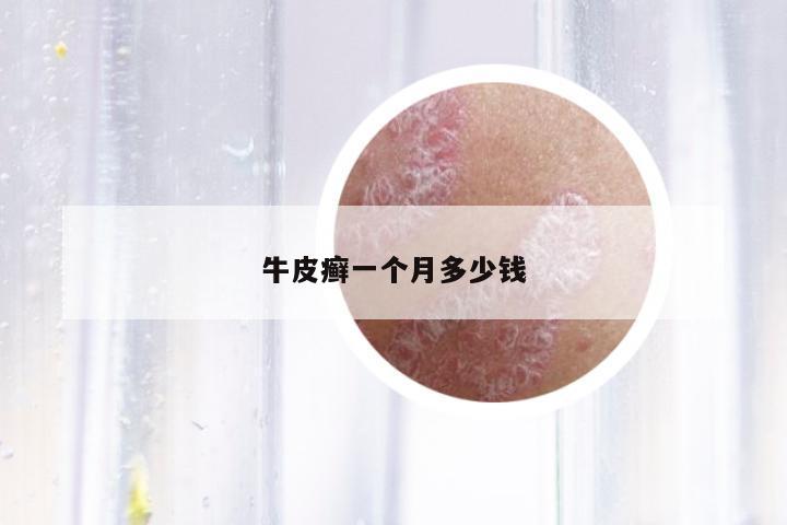 牛皮癬一個月多少錢
