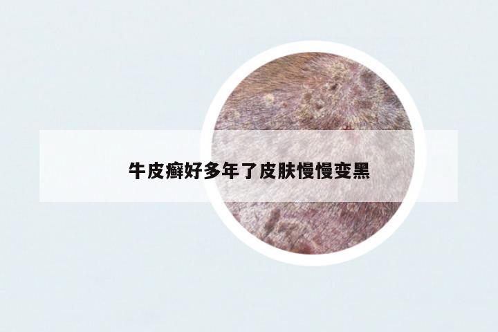 牛皮癬好多年了皮膚慢慢變黑