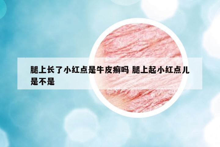 腿上長(zhǎng)了小紅點(diǎn)是牛皮癬嗎 腿上起小紅點(diǎn)兒是不是
