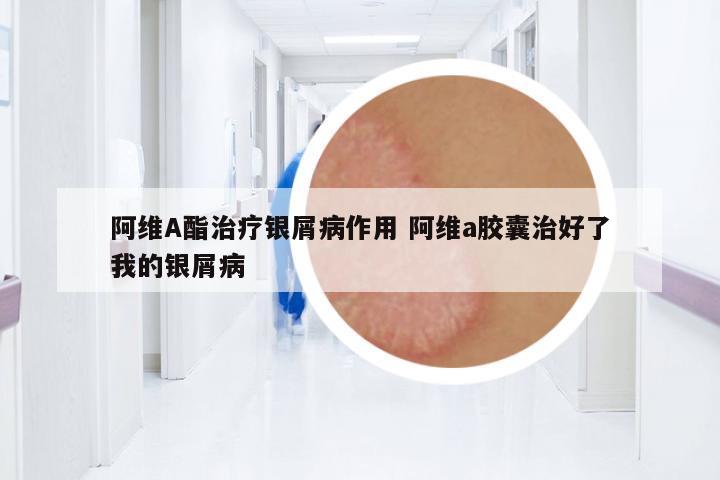 阿維A酯治療銀屑病作用 阿維a膠囊治好了我的銀屑病