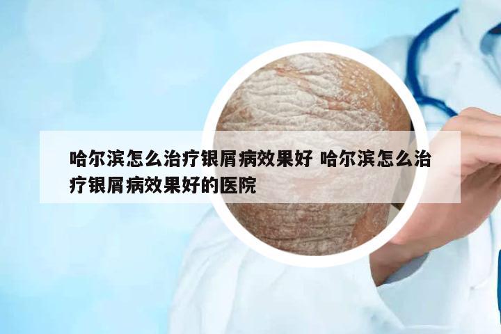 哈爾濱怎么治療銀屑病效果好 哈爾濱怎么治療銀屑病效果好的醫(yī)院