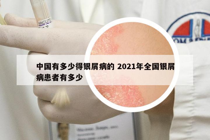 中國(guó)有多少得銀屑病的 2021年全國(guó)銀屑病患者有多少