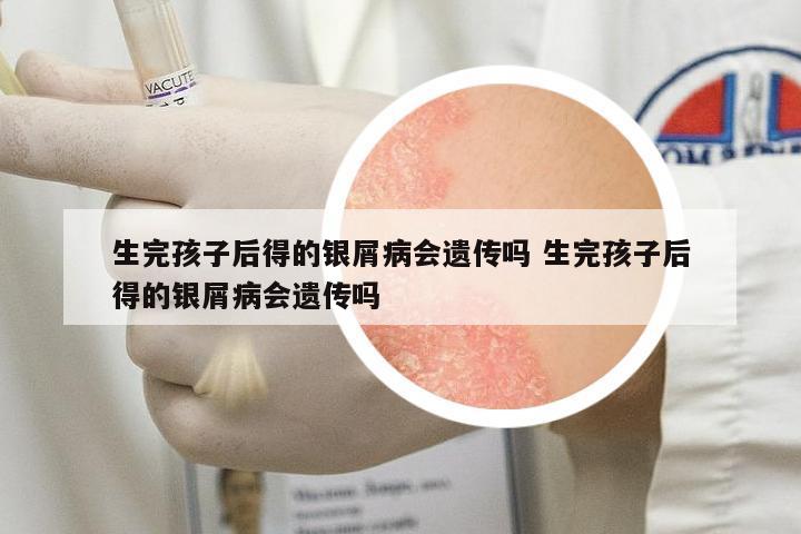 生完孩子后得的銀屑病會遺傳嗎 生完孩子后得的銀屑病會遺傳嗎